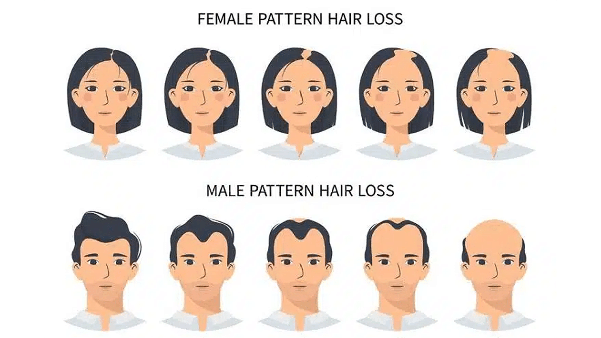 DNA alopecia